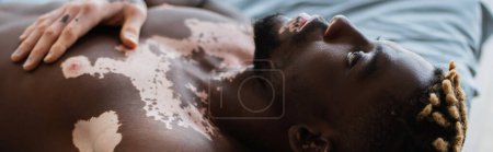 Shirtless african american man with vitiligo resting on bed at home, banner