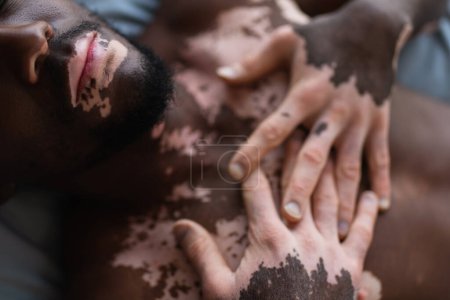 Top view of shirtless african american man with vitiligo lying on blurred bed at home