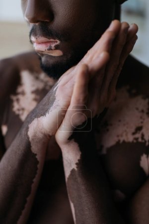 Cropped view of shirtless african american man with vitiligo standing with folded hands at home
