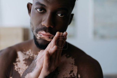 Porträt eines hemdslosen afrikanisch-amerikanischen Mannes mit Vitiligo, der zu Hause in die Kamera schaut 