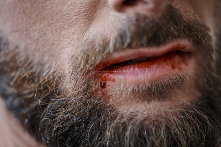 Ausgeschnittene Ansicht eines ängstlichen Mannes mit Bart, der während einer depressiven Episode seine Lippen bis zum Blut beißt