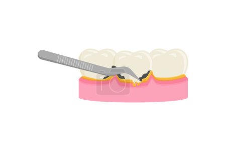 Téléchargez les illustrations : Mise à l'échelle des dents, retrait de la plaque dentaire pour le nettoyage et la santé - en licence libre de droit