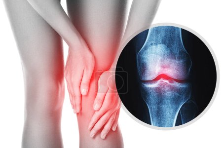 Weiblicher Knie- und Röntgeneffekt mit verletztem Gelenk