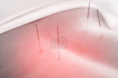 Photo for Alternative medicine. Close-up of female body with steel needles inserted during procedure of acupuncture therapy. - Royalty Free Image