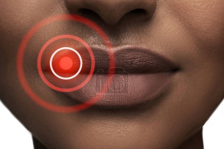 Téléchargez les photos : Gros plan des lèvres de la femme noire affectées par le virus herpès simplex. - en image libre de droit