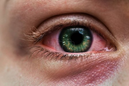 Foto de Primer plano del ojo femenino infectado con iris verde y hemorragia subconjuntival - Imagen libre de derechos