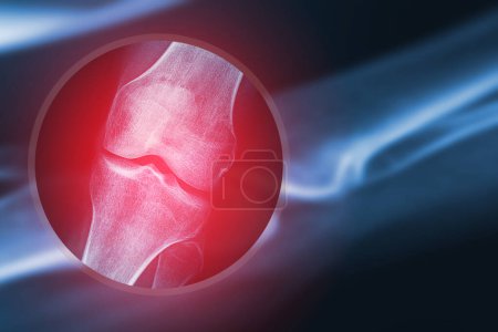 Photo for X-ray image of human knee. Problems with bone or joint. - Royalty Free Image