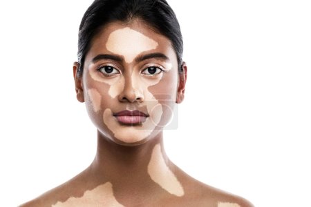 Porträt der schönen südasiatischen Frau mit Vitiligo-Hauterkrankung vor weißem Hintergrund