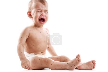 Téléchargez les photos : Bébé garçon avec la peau affectée par une éruption cutanée vésiculeuse à cause de la variole du singe ou de la varicelle sur fond blanc - en image libre de droit