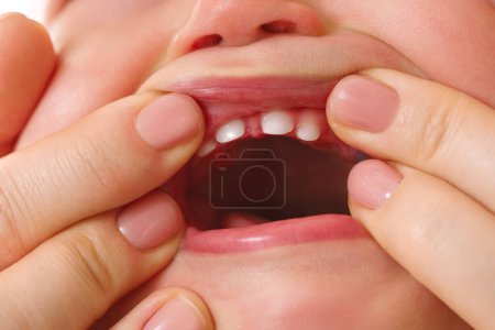 Foto de Primer plano de una madre abriendo la boca de su hijo pequeño con dientes caducos recién erupcionados - Imagen libre de derechos