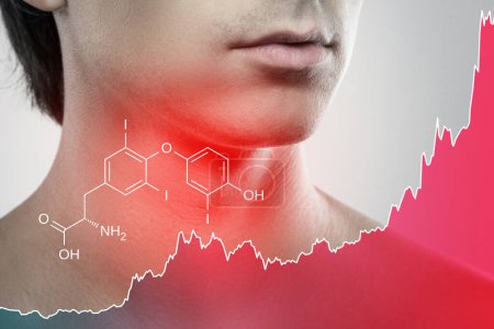 Photo for Male neck and chart of rising triiodothyronine hormone produced by thyroid - Royalty Free Image