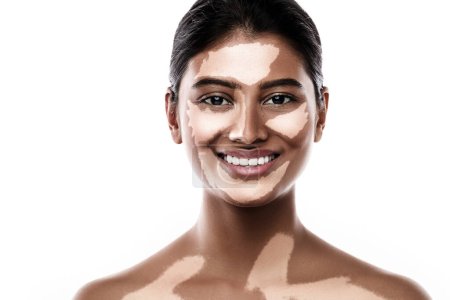 Foto de Retrato de hermosa mujer del sur de Asia con trastorno de la piel vitiligo contra fondo blanco - Imagen libre de derechos