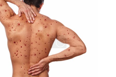 Foto de Espalda masculina afectada por erupción ampollosa debido a la varicela u otra infección viral en el fondo blanco - Imagen libre de derechos