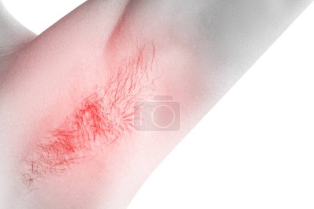 Foto de Primer plano de la axila femenina con enrojecimiento. Irritación de la piel o ganglio linfático inflamado. - Imagen libre de derechos