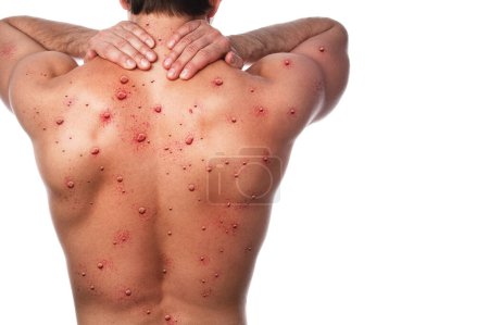 Foto de Espalda masculina afectada por erupción ampollosa debido a la varicela u otra infección viral en el fondo blanco - Imagen libre de derechos