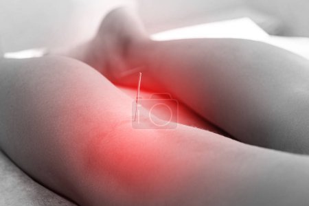Photo for Alternative medicine. Close-up of female popliteal fossa with steel needles inserted during procedure of acupuncture therapy. - Royalty Free Image