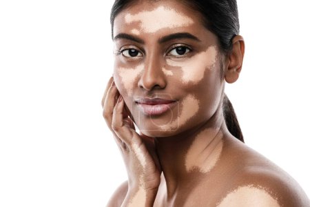 Foto de Retrato de hermosa mujer del sur de Asia con trastorno de la piel vitiligo contra fondo blanco - Imagen libre de derechos