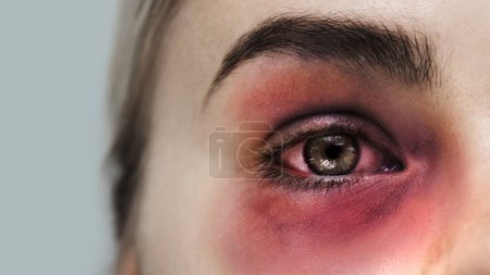 Photo for Woman victim of a domestic violence with bruise and subconjunctival hemorrhage - Royalty Free Image