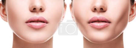 Téléchargez les photos : Comparaison du visage féminin après une extraction de graisse buccale réussie chirurgie plastique - en image libre de droit