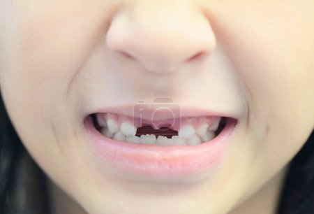 Photo for Lost milk teeth - lost baby tooth , smile face of a child girl baby teeth of tooth loss , her milk tooth fell out and her growing permanent tooth in open mouth dental health problems concept - Royalty Free Image