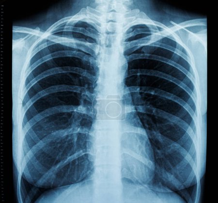 Photo for Fluorography of the human chest, frontal x-ray. - Royalty Free Image