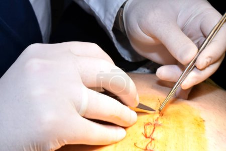 Téléchargez les photos : Les mains d'un chirurgien qui utilise une pince à épiler et un scalpel pour enlever les fils d'une suture sur le ventre du patient. - en image libre de droit