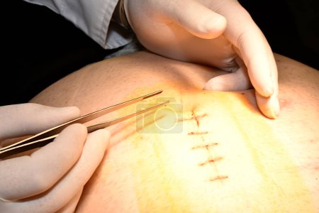 Photo for Hands of a doctor who removes threads with tweezers from a surgical suture on the abdomen. - Royalty Free Image