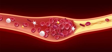 Ilustración 3D de glóbulos rojos y coágulos de colesterol causan la muerte.