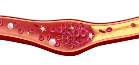 3D-Illustration von roten Blutkörperchen und Cholesterinklumpen verursachen Tod.