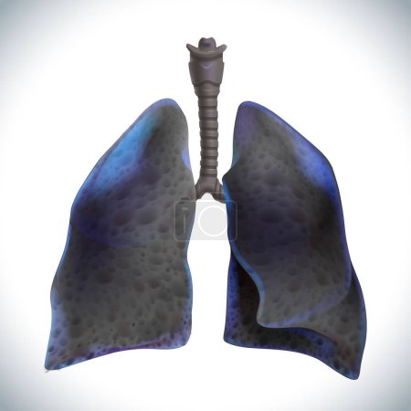 Foto de Ilustración 3D de dos pulmones con cáncer en las etapas finales donde el tejido pulmonar se ha vuelto negro. - Imagen libre de derechos