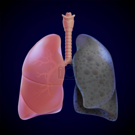 Illustration for 3D illustration of healthy human lungs and smoking lung, lung cancer on a blue-black background. - Royalty Free Image