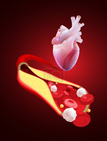 Illustration for 3D illustration of a blocked human coronary artery presents a close-up view of the blood vessel cross-section and dissecting it to reveal the inside. - Royalty Free Image