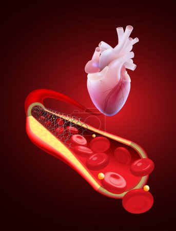 Ilustración de Ilustración 3D de una arteria coronaria humana con flujo sanguíneo normal tras angioplastia con stent. - Imagen libre de derechos