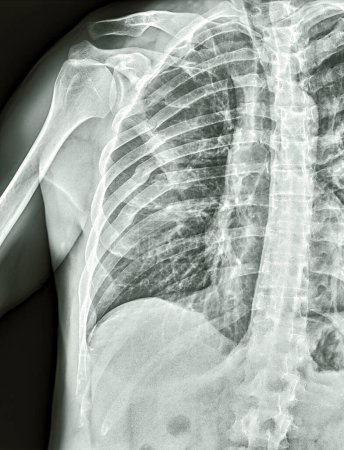 Radiografía de rayos X hombro derecho con muchas costillas rotas y dislocación de hombro caja torácica