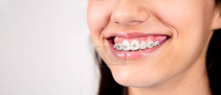 Photo for Mouth of a teen girl smiling showing metal orthodontics. White background and copy space - Royalty Free Image