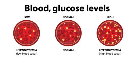 Blut, Glukosespiegel. Glukose im Blutgefäß. Normalwert, Hyperglykämie (hoher Blutzucker), Hypoglykämie (niedriger Blutzucker). Vektordiagramm. Blutzuckertest. Diabetes-Insulin