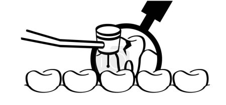 Illustration for Dentist drill or dental drill for dental clinic. Cartoon tooth with gums and tooth drill, Molar logo. Damage teeth brush or tooth brush with caries. Mouth hygiene symbol. Tooth drilling machine. - Royalty Free Image