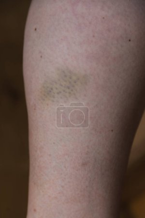 Photo for Bruise on the lower leg, bruise - hematoma, injury - Royalty Free Image