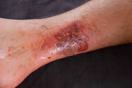 Foto de Un hombre con una pierna con una herida roja en la pierna. - Imagen libre de derechos