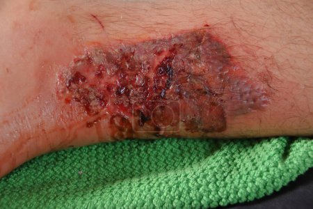 man with wound wound on leg, wound wound on leg