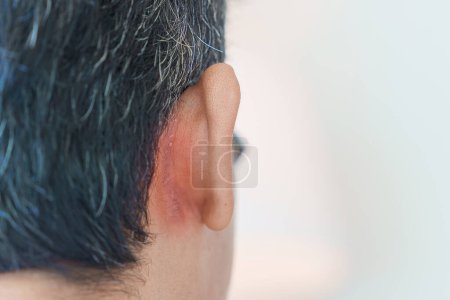 Foto de Hombre que tiene problemas de oído debido a la dermatitis seborreica, psoriasis, tiña e infección micótica de la piel - Imagen libre de derechos
