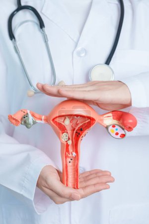 Foto de Doctor holding Uterus and Ovaries model. Ovarian and Cervical cancer, Cervix disorder, Endometriosis, Hysterectomy, Uterine fibroids, Reproductive system and Pregnancy concept - Imagen libre de derechos