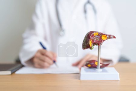 Doctor with human Liver anatomy model. Liver cancer and Tumor, Jaundice, Viral Hepatitis A, B, C, D, E, Cirrhosis, Failure, Enlarged, Hepatic Encephalopathy, Ascites Fluid in Belly and health concept
