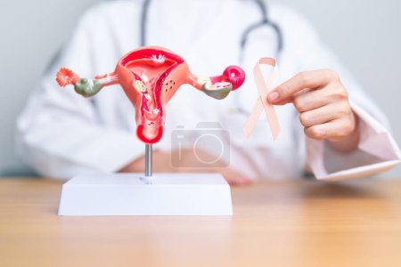 Arzt hält Pfirsichband mit Uterus und Eierstöcken Modell für September Uterine Cancer Awareness Monat. Endometriose, Hysterektomie, Myome der Gebärmutterschleimhaut, Fortpflanzung, Gesundheitswesen und Weltkrebstag