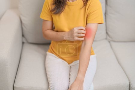 Photo for Woman itching and scratching itchy arm. Sensitive Skin Allergic reaction to insect bite, food, drug dermatitis. Dermatology, Leprosy day, Systemic lupus erythematosus, Allergy symptoms and rash Eczema - Royalty Free Image