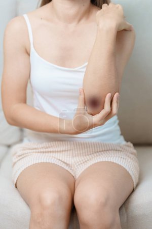 Contusions, contusions et contusions. Femme ayant des ecchymoses au coude et au bras dues à un accident. Lésions cutanées, douleurs et douleurs corporelles