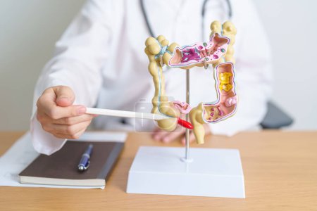 Doctor with human Colon anatomy model. Colonic disease, Large Intestine, Colorectal cancer, Ulcerative colitis, Diverticulitis, Irritable bowel syndrome, Digestive system and Health concept