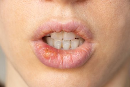 Téléchargez les photos : Herpès simplex sur les lèvres d'une fille gros plan, un groupe de maladies virales avec une éruption cutanée caractéristique de vésicules groupées sur la lèvre - en image libre de droit