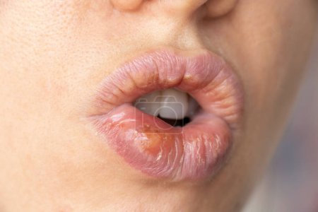 Téléchargez les photos : Herpès simplex sur les lèvres d'une fille gros plan, un groupe de maladies virales avec une éruption cutanée caractéristique de vésicules groupées sur la lèvre - en image libre de droit