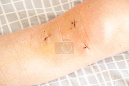Sutures postopératoires sur le genou et le bas de la jambe après le remplacement du ménisque chez un homme, incisions cousues